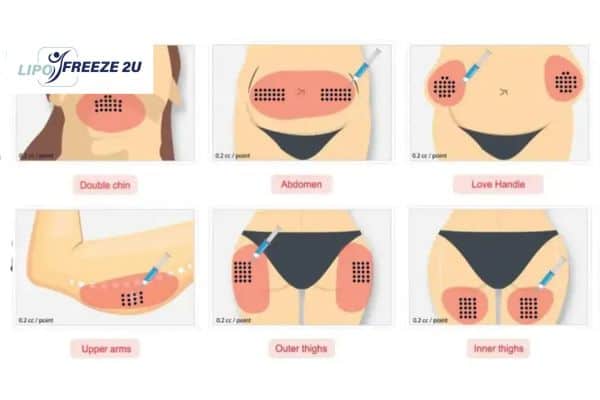 Benefits of Choosing Aqualyx for Fat Reduction Southampton