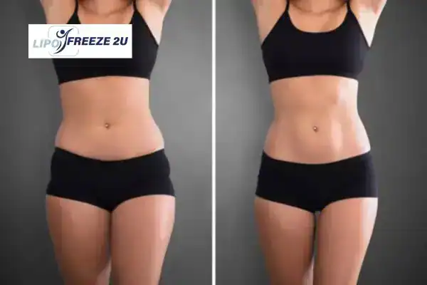 How Can LIPO FREEZE 2U Support Your Post-Pregnancy Body Recovery Southampton?