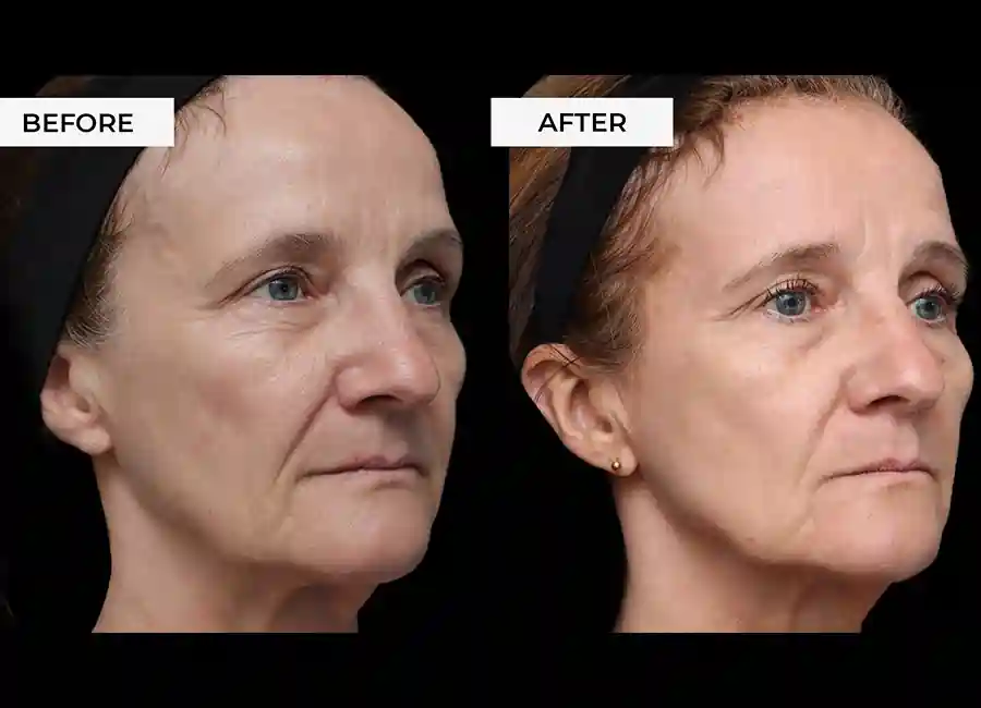 How Many RF Microneedling Sessions Will You Need to See a Difference Southampton?