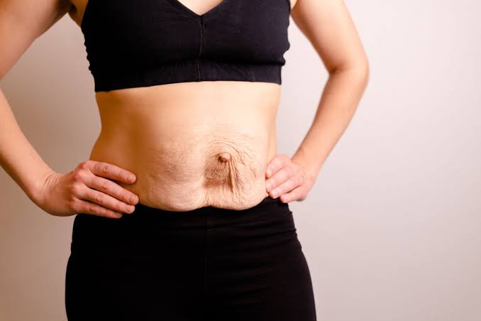 Is Surgery Really the Only Way to Repair Diastasis Recti Southampton?
